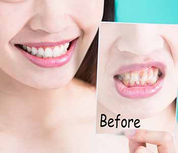 Dental care Before and After