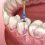 Relieve Pain and Save Your Tooth with a Greensboro, North Carolina Dentist for Root Canal