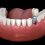 What can I expect before, during, and after dental implant surgery?