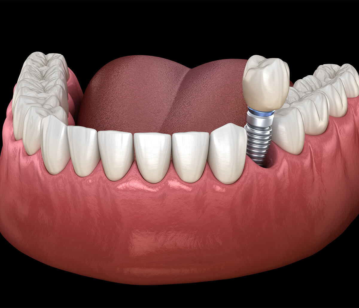 Dental Implant Surgery in Greensboro NC Area