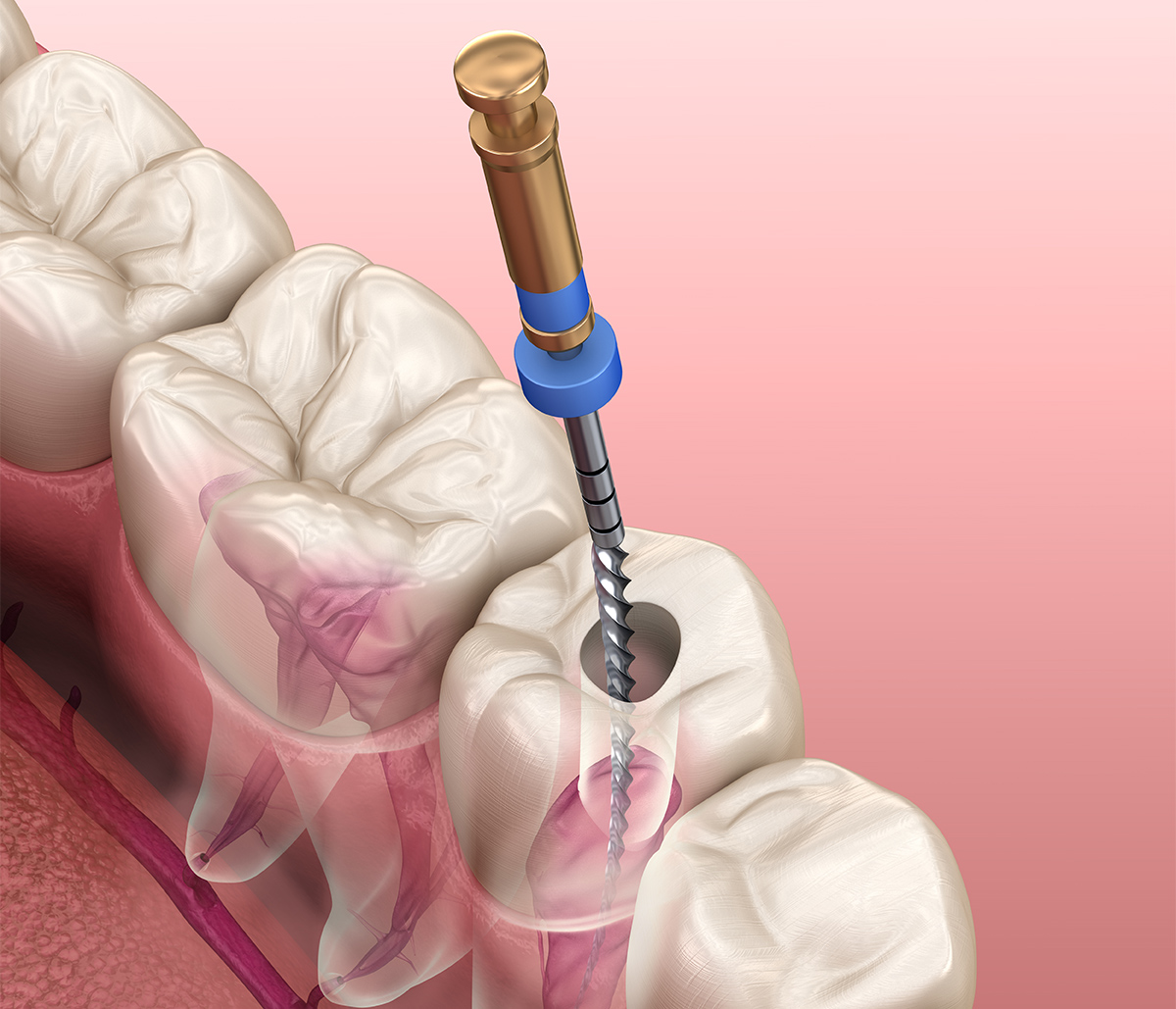 Painless Root Canals with Sedation in Greensboro NC Area